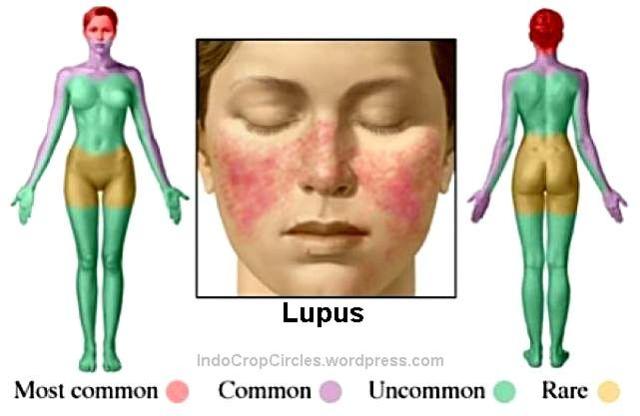 penyakit Lupus - kulit