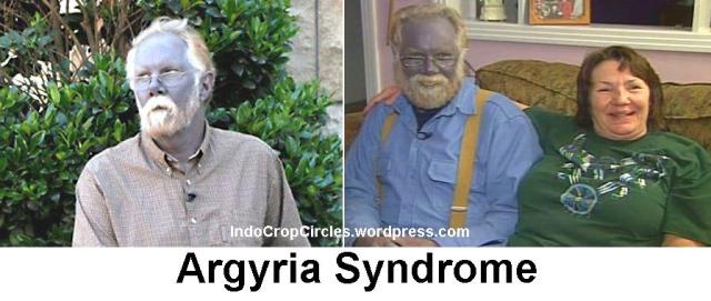 Argyria Syndrome