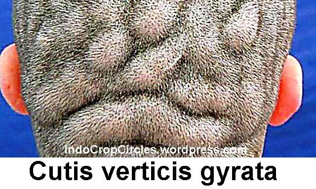 Cutis verticis gyrata-penyakit-langka-kulit-kepala-sepertri-permukaan-otak