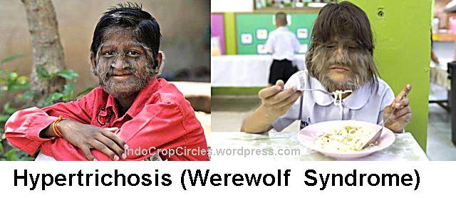 Hypertrichosis (Werewolf  Syndrome)