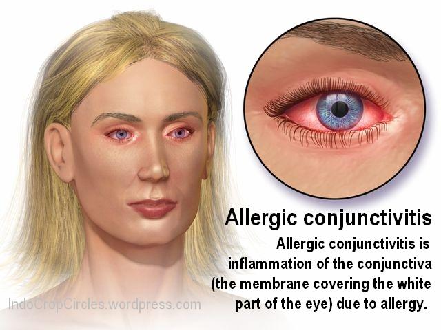 Allergic Conjunctivitis